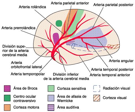 acv arteria cerebral media izquierda